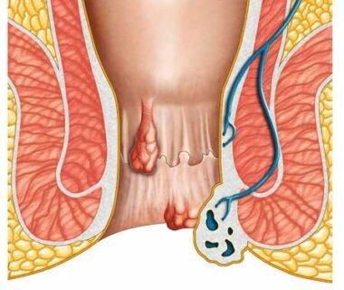 Best fistula treatment in Dubai
