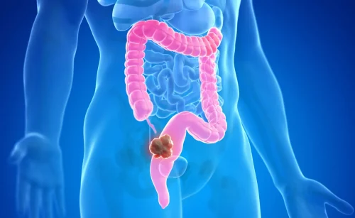 Can Colon Cancer Be Completely Cured?