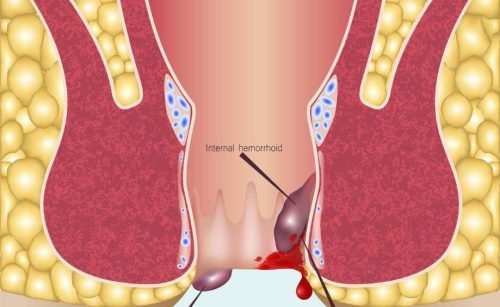best piles treatment in dubai
