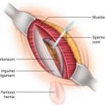 Hernia surgery recovery time