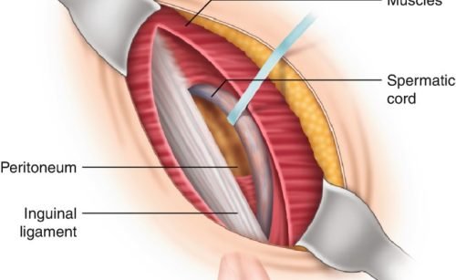 Hernia surgery recovery time