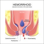 Which Treatment Is Best for Hemorrhoids?
