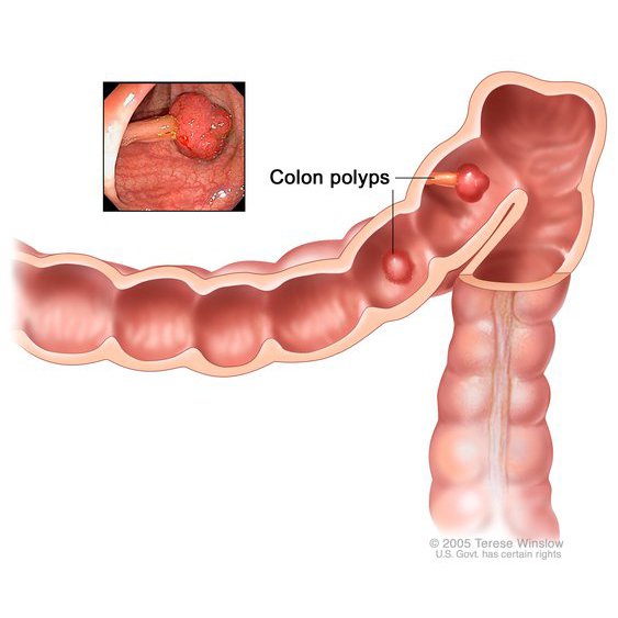How to Remove Colon Polyps Without Surgery